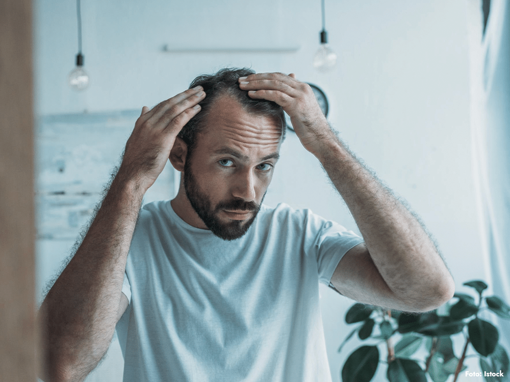Man tittar på en glesnande hjässa – tecken på ärftligt håravfall (androgenetisk alopeci), manligt håravfall.