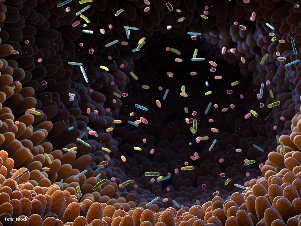 Illustration av tarmens slemhinna och tarmbakterier vid inflammatoriska tarmsjukdomar, med koppling till ökad risk för kolorektalcancer.