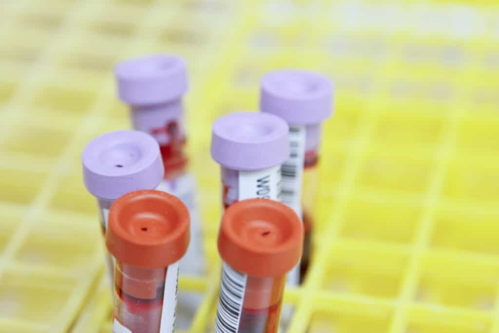 Biomarkörer i blodet kan ge tidiga signaler om risken för multisjuklighet 2 Provrör med blod för blodprov – analys av biomarkörer i blodet som HbA1c (långtidsblodsocker) kan kopplas till risk för multisjuklighet.