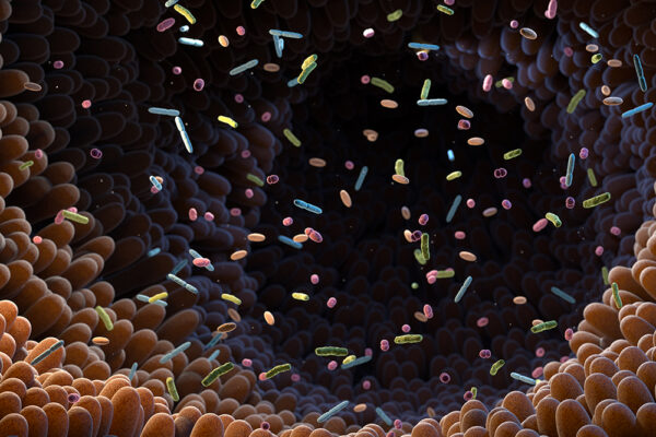 Illustration av tarmens slemhinna och tarmbakterier vid inflammatoriska tarmsjukdomar, med koppling till ökad risk för kolorektalcancer.